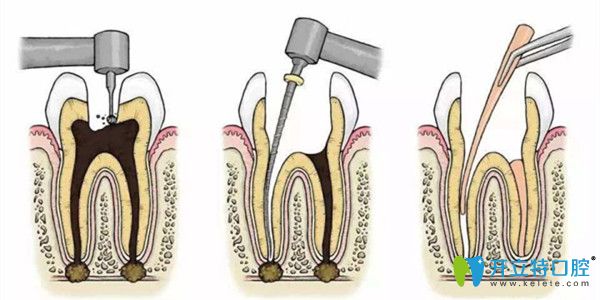 根管治療對(duì)技術(shù)要求較高 根管治療對(duì)技術(shù)要求較高