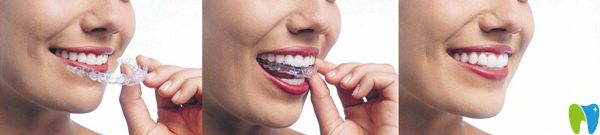 隱形牙套佩戴圖示