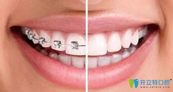 長(zhǎng)沙牙齒矯正價(jià)格表