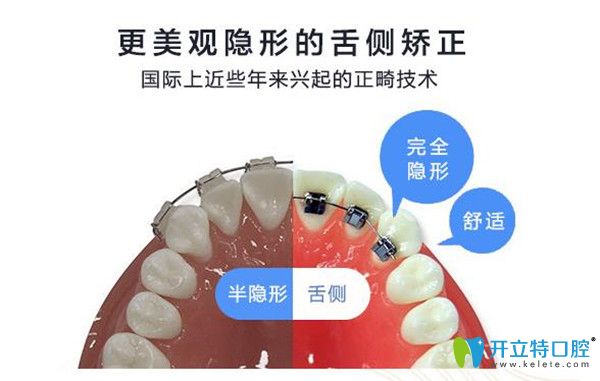 傳統(tǒng)牙套與舌側(cè)矯正對比