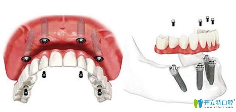 缺牙后一步到位直接選擇種植牙