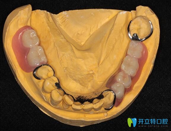 廣州柏德口腔閆振介紹可摘局部義齒優(yōu)勢(shì) 廣州柏德口腔閆振介紹可摘局部義齒優(yōu)勢(shì)