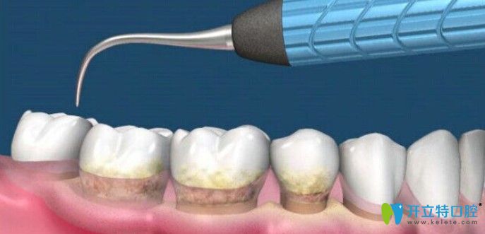 李懿來(lái)告訴大家為什么醫(yī)生不建議做齦下刮治？