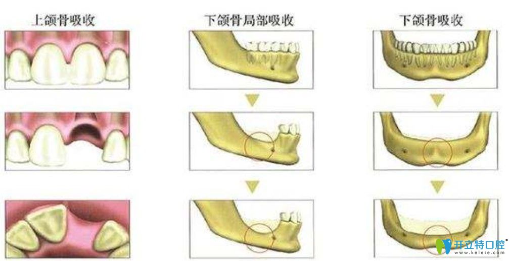 牙槽骨客觀條件過(guò)差會(huì)導(dǎo)致假牙脫落
