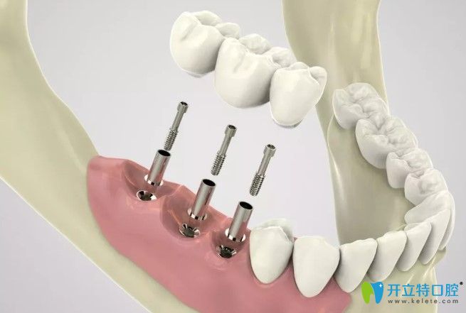 李奇?zhèn)メt(yī)生告訴你怎么延長種植牙壽命 李奇?zhèn)メt(yī)生告訴你怎么延長種植牙壽命