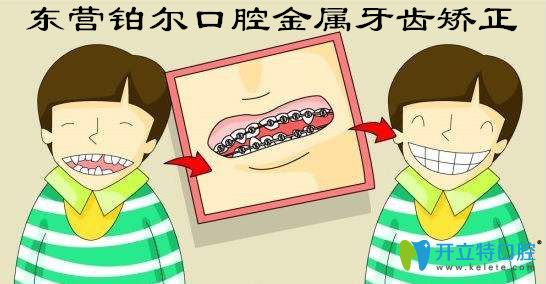 畸形牙齒矯正福利!東營(yíng)鉑爾口腔金屬矯正8800元起免費(fèi)拍牙片