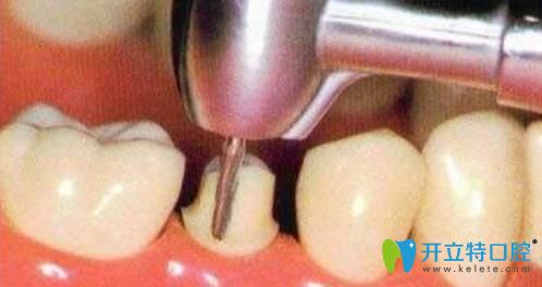 烤瓷牙磨牙磨多少