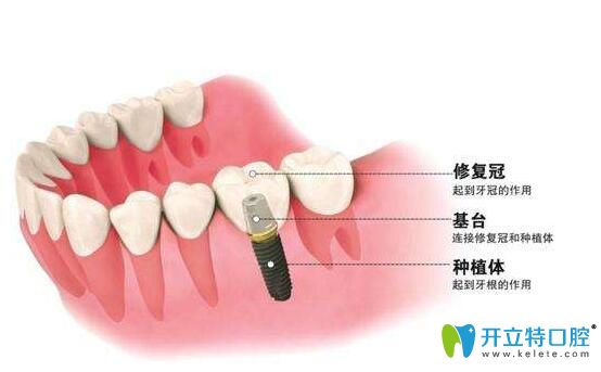 寧波恒美口腔李莎醫(yī)生介紹種植牙價格