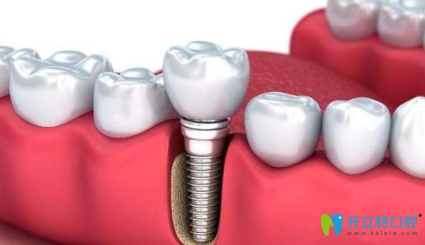 德國進口種植牙圖 德國進口種植牙圖