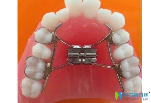 李可君講解牙齒矯正的擴弓器利弊是什么