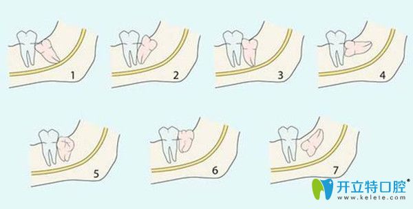阻生智齒的七種情況