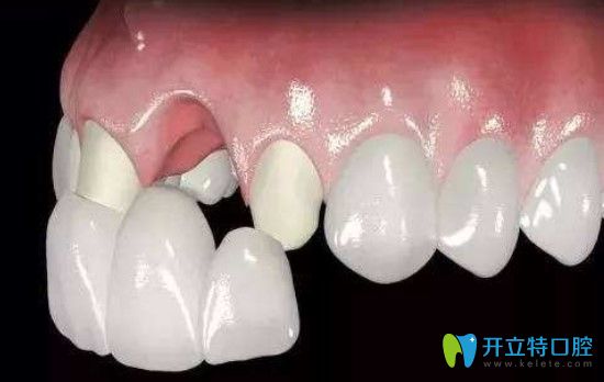 張麗華醫(yī)生告訴大家十八歲之前做烤瓷牙的后果有哪些 張麗華醫(yī)生告訴大家十八歲之前做烤瓷牙的后果有哪些