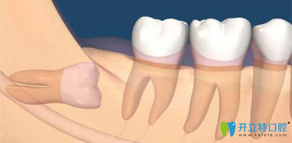 智齒齲壞要及時拔除