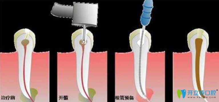 李文英講解什么是根管治療牙齒 李文英講解什么是根管治療牙齒