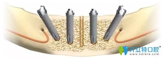 All-on-4半口種植修復(fù)技術(shù)示意圖 All-on-4半口種植修復(fù)技術(shù)示意圖