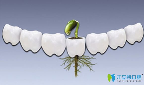 種植牙哪個品牌好