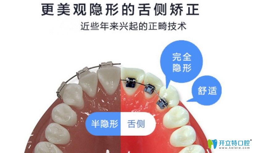 舌側(cè)隱形矯正缺點(diǎn)