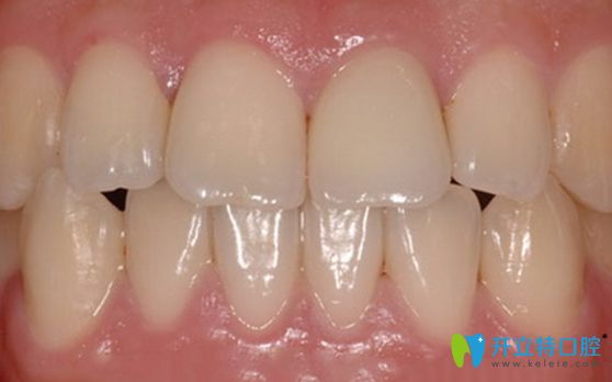 經(jīng)過(guò)牙齦移植手術(shù)后健康正常的牙齦圖