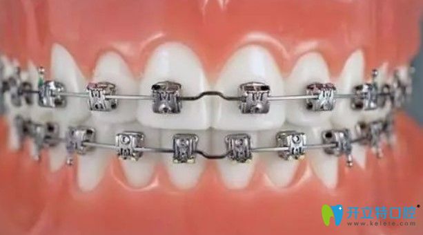 美奧與damon牙套哪個(gè)矯正效果好