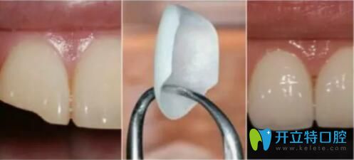 看看深圳牙齒貼面價(jià)格附做的好的口腔醫(yī)院名單,你中意哪個(gè)