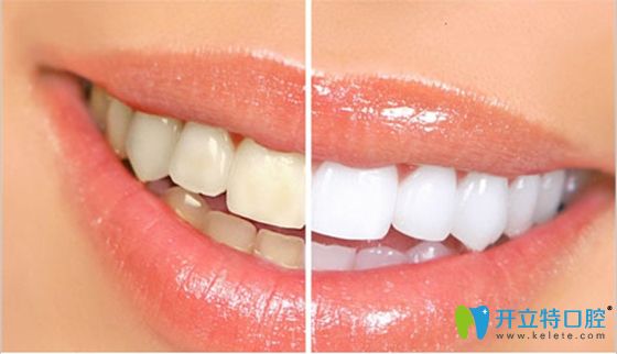 天津愛(ài)齒口腔皓齒美白價(jià)格很優(yōu)惠