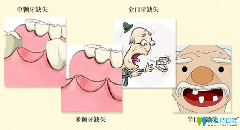 韓國sg與瑞士百丹特種植牙價(jià)格