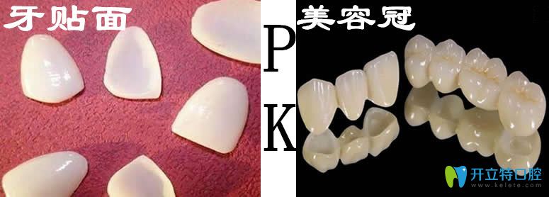 流行的牙齒美容方法牙貼面和美容冠哪個(gè)好,有什么區(qū)別？
