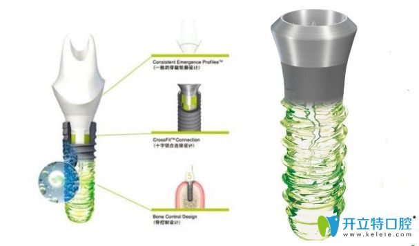 以色列雅定親水種植體和瑞士iti親水種植體相比哪個更好