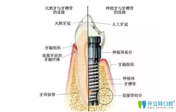 韓國SG種植牙好不好