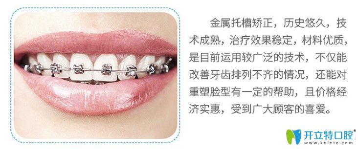 金屬自鎖托槽矯正優(yōu)勢(shì) 金屬自鎖托槽矯正優(yōu)勢(shì)