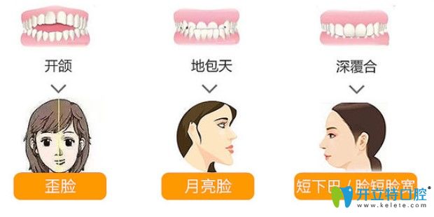 什么是陶瓷自鎖托槽矯正 什么是陶瓷自鎖托槽矯正