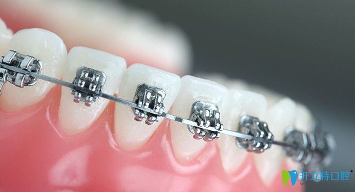 矯正后需要戴保持器鞏固 矯正后需要戴保持器鞏固