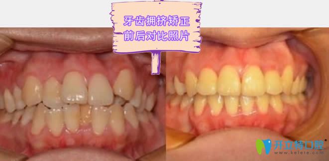 東營鉑爾口腔牙齒擁擠矯正效果