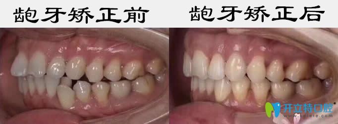 成人牙齒矯正可借鑒東營(yíng)鉑爾口腔齙牙和牙齒擁擠矯正效果