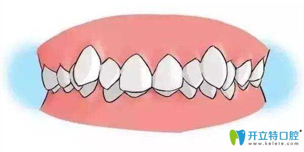 哪些情況需要做牙齒矯正 哪些情況需要做牙齒矯正