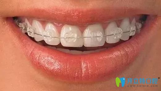 半隱形牙套會刮嘴?分享在做陶瓷托槽半隱形感受