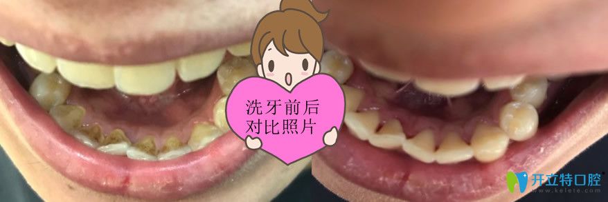 在東營鉑爾口腔洗牙前后照片