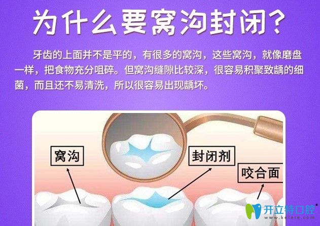 聽(tīng)圣貝牙科醫(yī)生說(shuō)為什么要窩溝封閉