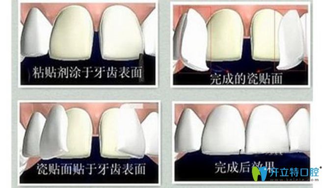 牙齒貼面步驟圖解 牙齒貼面步驟圖解