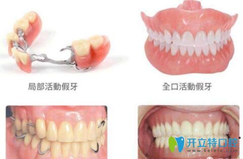 深圳鑲牙技術(shù)哪家好?整理鑲牙價格和烤瓷牙好的醫(yī)院供參考