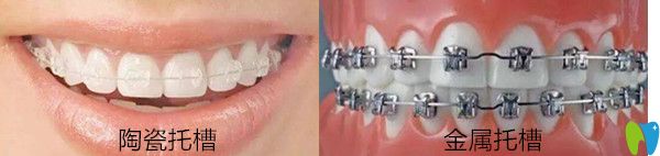 隱適美和金屬自鎖托槽區(qū)別,哪個(gè)好? 什么情況不能用隱適美