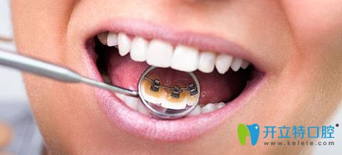 舌側(cè)矯正效果圖 舌側(cè)矯正效果圖