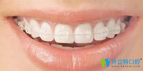 傳統(tǒng)透明托槽矯正圖片 傳統(tǒng)透明托槽矯正圖片