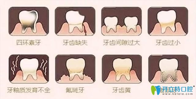 適合做牙齒貼面的一些情況 適合做牙齒貼面的一些情況