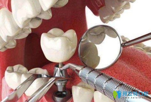 王君瑋醫(yī)生解：種植牙和真牙一樣嗎