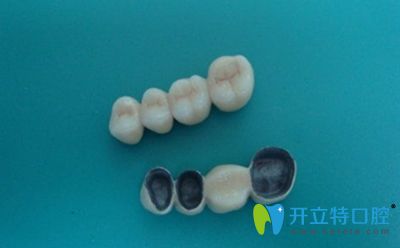 李會彬醫(yī)生簡介烤瓷冠橋修復(fù)方法 李會彬醫(yī)生簡介烤瓷冠橋修復(fù)方法