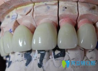 全瓷冠修復(fù)效果圖 全瓷冠修復(fù)效果圖