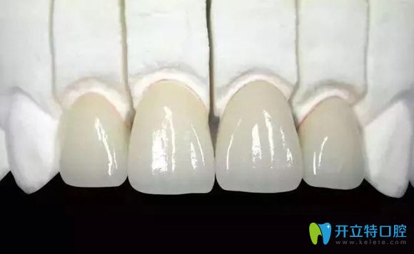 <!--<i data=20240703-sp></i>-->全瓷牙多少錢(qián)一顆的價(jià)格在這里