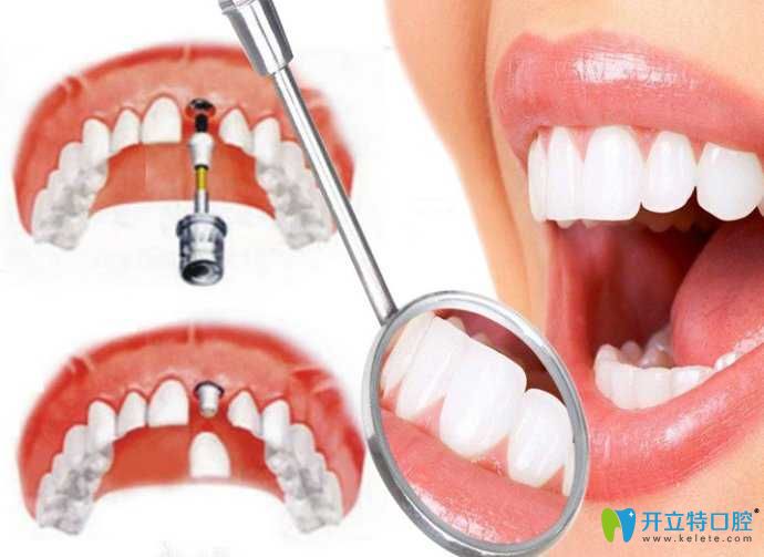 寧波恒美口腔王曉光介紹種植牙適應(yīng)癥 寧波恒美口腔王曉光介紹種植牙適應(yīng)癥