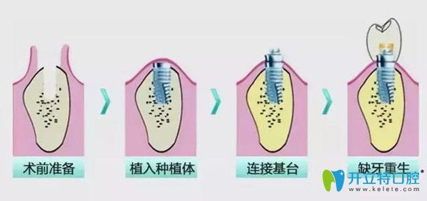 即刻種植牙 即刻種植牙